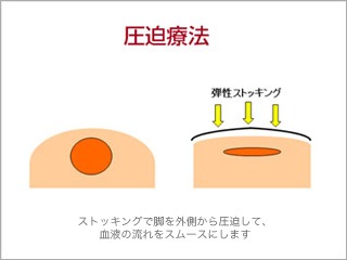 圧迫療法（保存的療法）