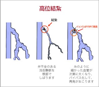 高位結紮