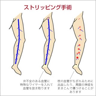 ストリッピング