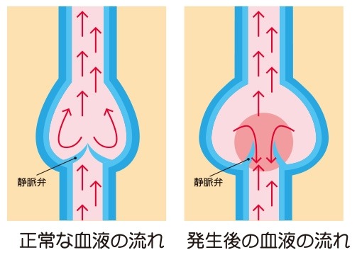 下肢静脈瘤の原因