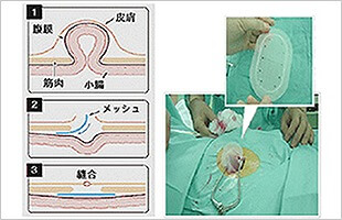 鼠径ヘルニアの日帰り手術