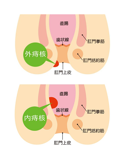 いぼ痔