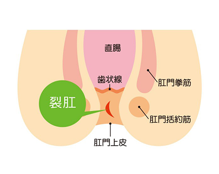 切れ痔（裂肛）