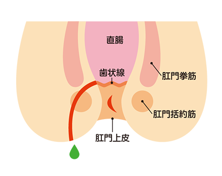 痔ろう（うみ痔）