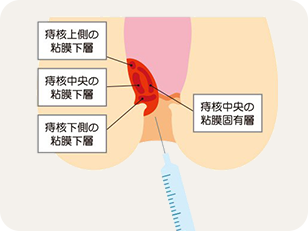 ジオン注射（ALTA療法）