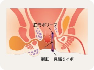 慢性期の治療