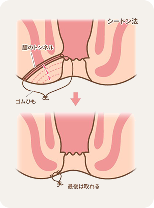 痔ろうの治療