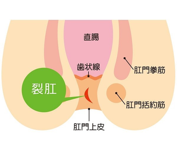 切れ痔の手術