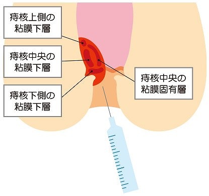 ジオン注射(ALTA療法)