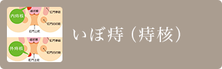 いぼ痔（痔核）