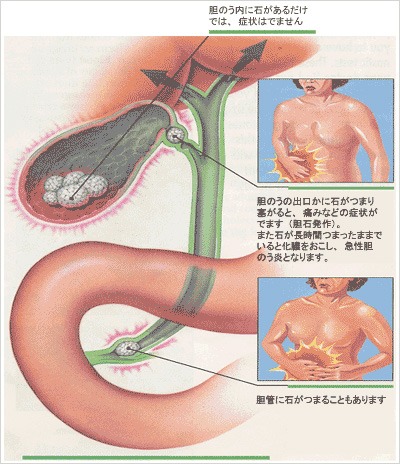 発作 胆石 疾患と治療方法 ～胆石症とその治療について～