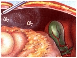 炭酸ガスを注入して腹腔を膨らませ、手術をするためのスペースを作り出します。