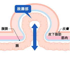 このような症状は、鼠径ヘルニアが原因かもしれません