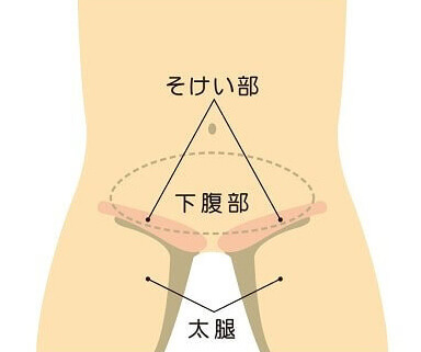 鼠径ヘルニアは、主に3種類