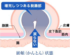 鼠径ヘルニアの嵌頓(かんとん)とは？