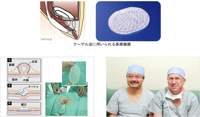 鼠径ヘルニアの手術について