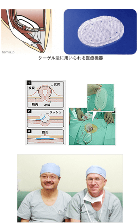 鼠径ヘルニアの手術について